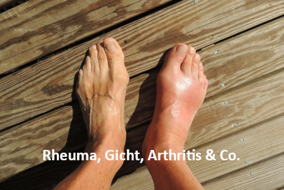 Beitrag "Rheuma, Gicht, Arthritis & Co." | menssensus® Institut Forschungsinstitut & Therapiezentrum Zülpich